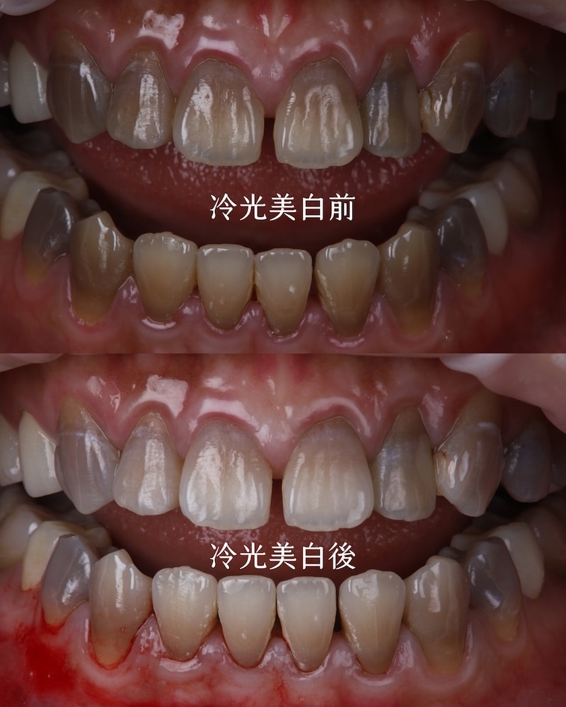 重度四環黴素染色，冷光美白前後對比，將深灰色牙齒基底提亮，有助後續貼片遮色與自然融合