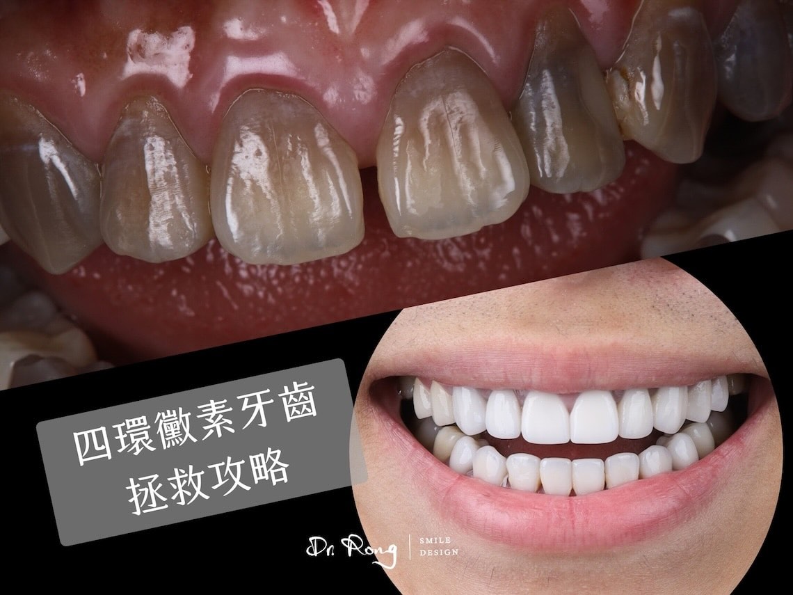 四環黴素牙齒-染色-四環素牙-冷光美白-全瓷貼片-推薦-台北-許家榕醫師