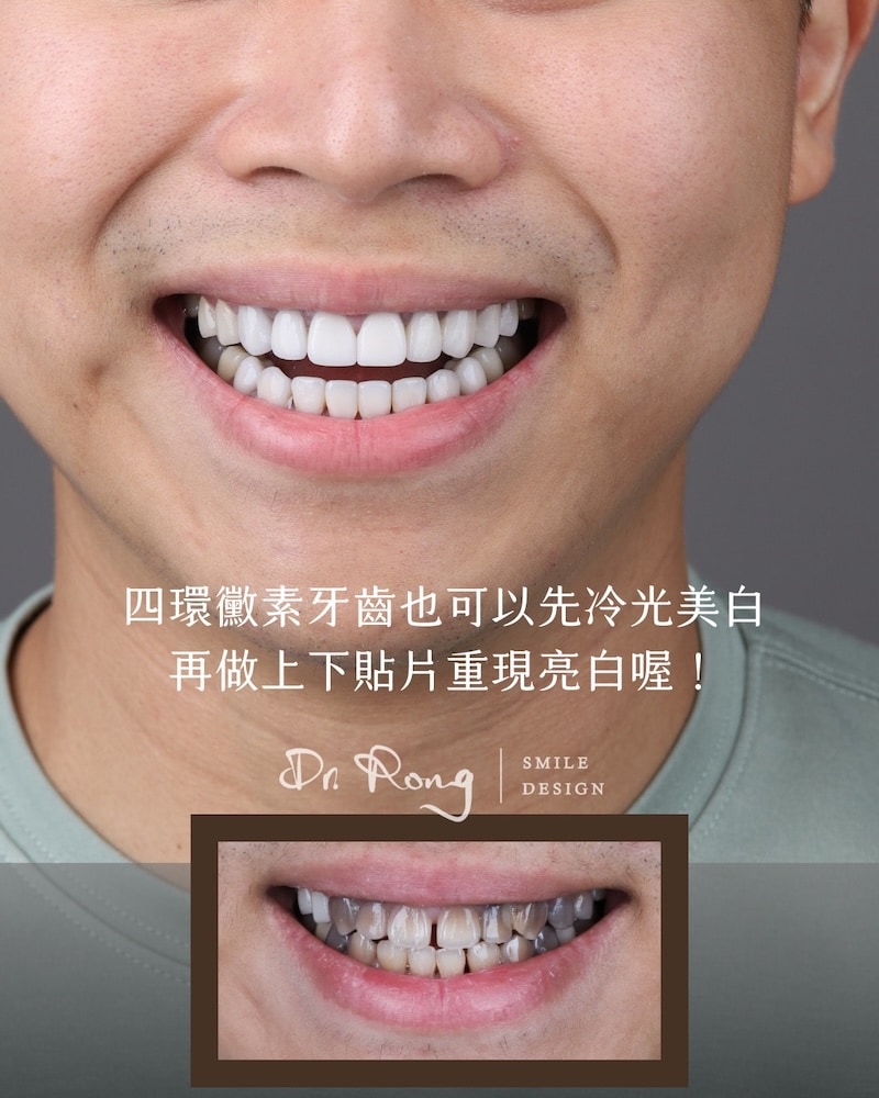 重度四環黴素牙齒治療前後笑容對比照，透過冷光美白與全瓷貼片遮色，改善牙齒灰黑感與色階不均，重現自然白皙笑容