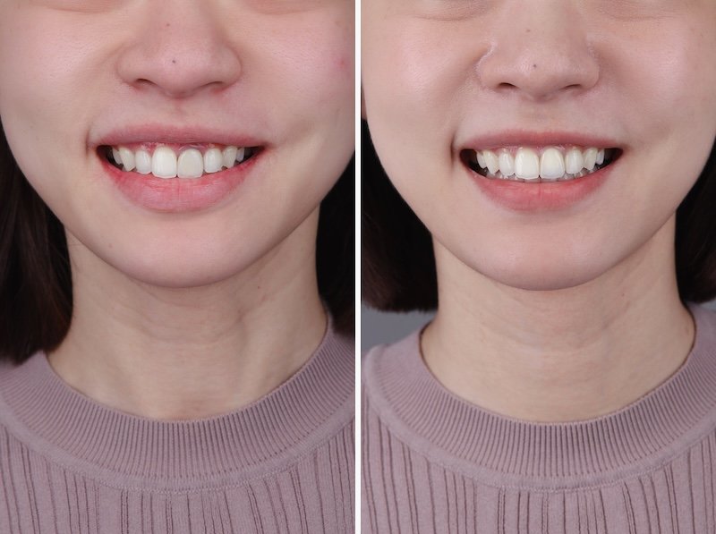 陶瓷貼片重製前後對比，使用 Vita RealLife 瓷塊成功改善門牙灰暗問題，恢復自然透亮的層次感