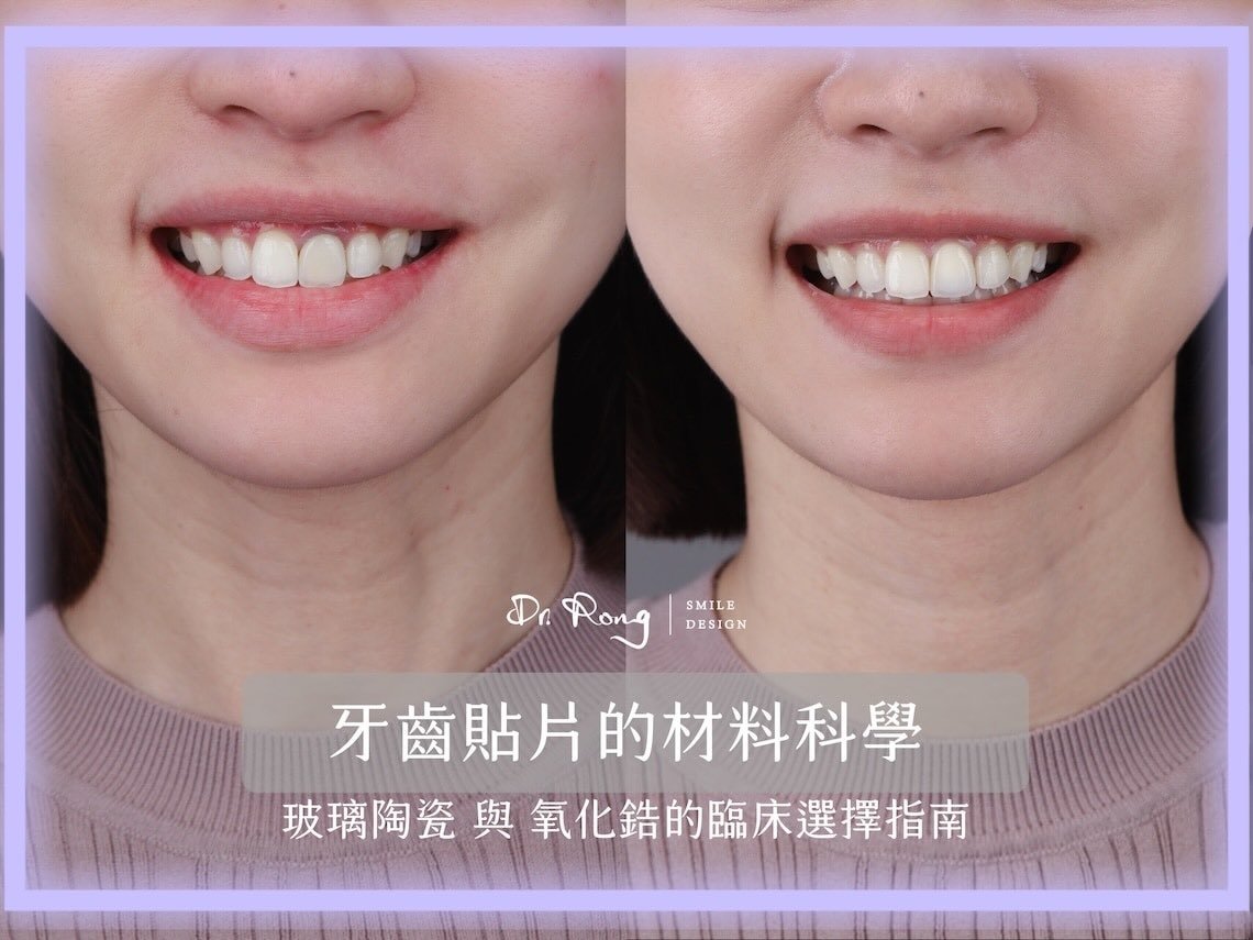牙齒貼片材質-玻璃陶瓷牙齒-氧化鋯假牙-陶瓷貼片-推薦-台北-許家榕醫師