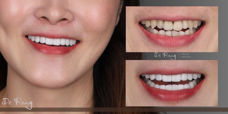 20顆陶瓷貼片與全瓷冠重建案例，同步改善牙齒黃、排列不整與咬合問題