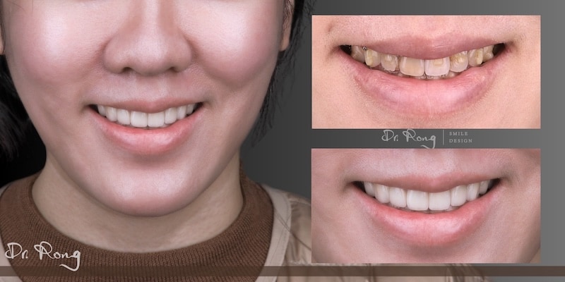 冷光美白搭配上排8顆陶瓷貼片案例，調整牙齒色階與笑容整體協調度