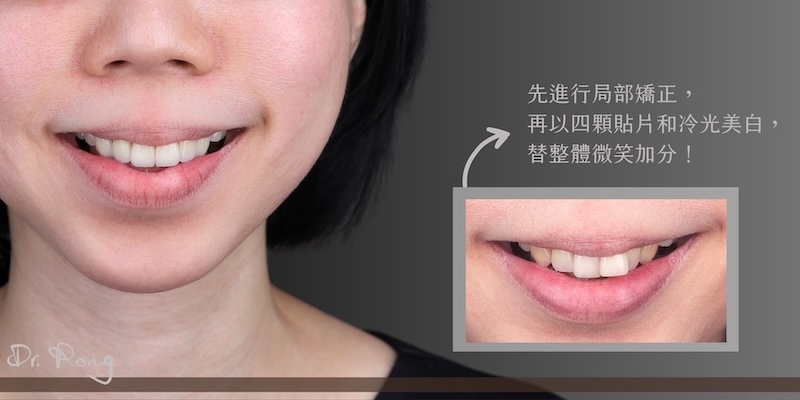 局部矯正+陶瓷貼片+冷光美白組合治療後的自然微笑成果