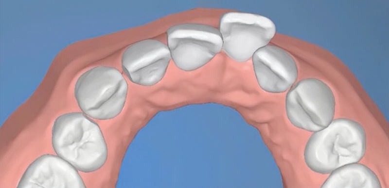 治療前牙齒數位排列模型,顯示前牙位置外突