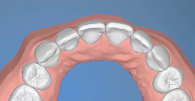 局部矯正後牙齒數位排列模型,前牙位置內收