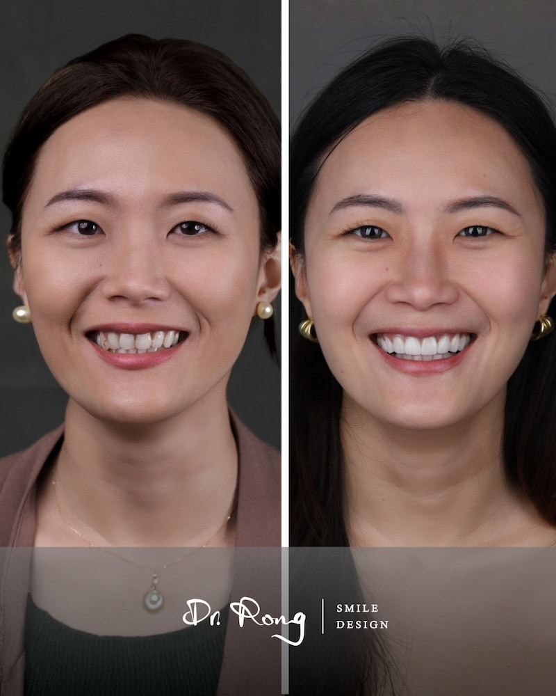 陶瓷貼片療程前後正面笑容對比照，改善牙齒染色與泛黃，重建自然亮白笑容