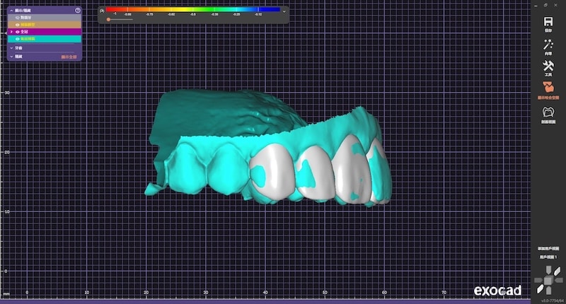 DSD數位微笑設計陶瓷貼片側面模擬圖(患者右側)