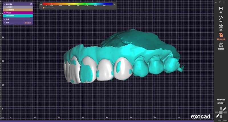 DSD數位微笑設計陶瓷貼片側面模擬圖(患者左側)