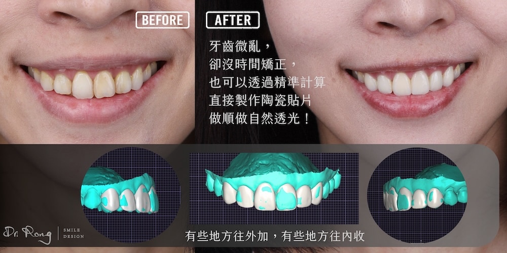 牙齒沒有很亂-不矯正貼片案例-許家榕醫師-台北