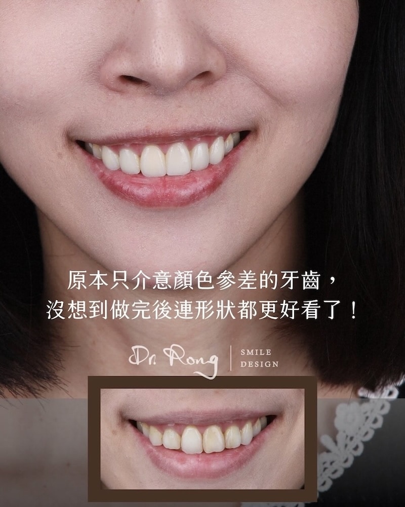 牙齒沒有很亂經陶瓷貼片改善後的笑容前後對比