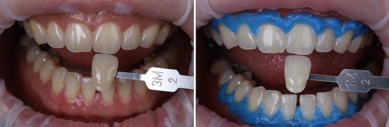 冷光美白療程前後對比圖,全口齒色由偏黃轉為較明亮