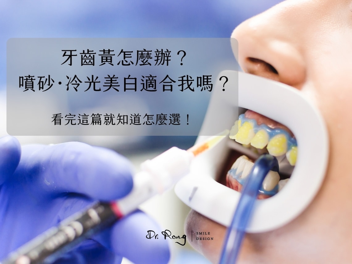 牙齒黃-牙齒美白-噴砂美白-冷光美白-居家美白-台北-推薦-許家榕醫師