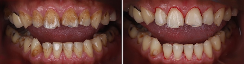 噴砂美白療程前後對比圖,清除牙齒表面沉積後齒色變得較均勻