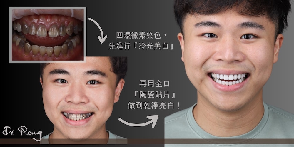 四環黴素牙齒-冷光美白-陶瓷貼片-推薦-許家榕醫師-台北