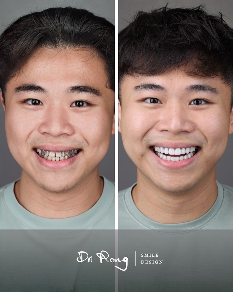 四環黴素牙全口陶瓷貼片治療前後對比,灰黑色條紋染色改善後笑容自然潔白
