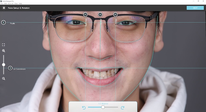 DSD微笑設計臉部比例分析，評估陶瓷貼片後整體笑容