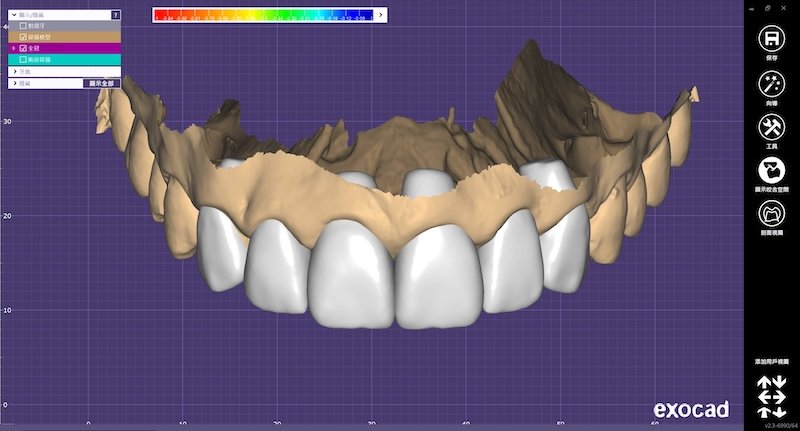 DSD數位微笑設計3D模型，模擬陶瓷貼片後牙齒形態與比例