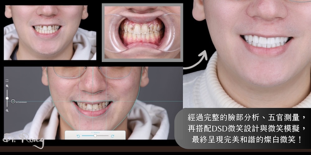 樹脂變色-牙齒變色-陶瓷貼片-dsd微笑設計-推薦-許家榕醫師-台北