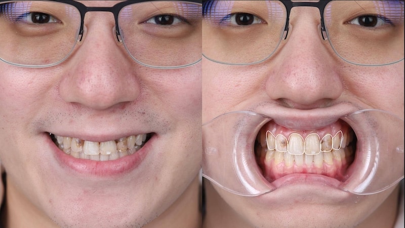 陶瓷貼片設計前牙齒狀況與排列評估，記錄牙齒顏色、形態與咬合關係