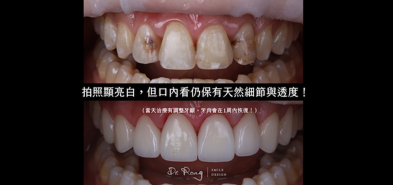 陶瓷貼片治療前後對比，改善牙齒變色與型態，呈現自然笑容效果
