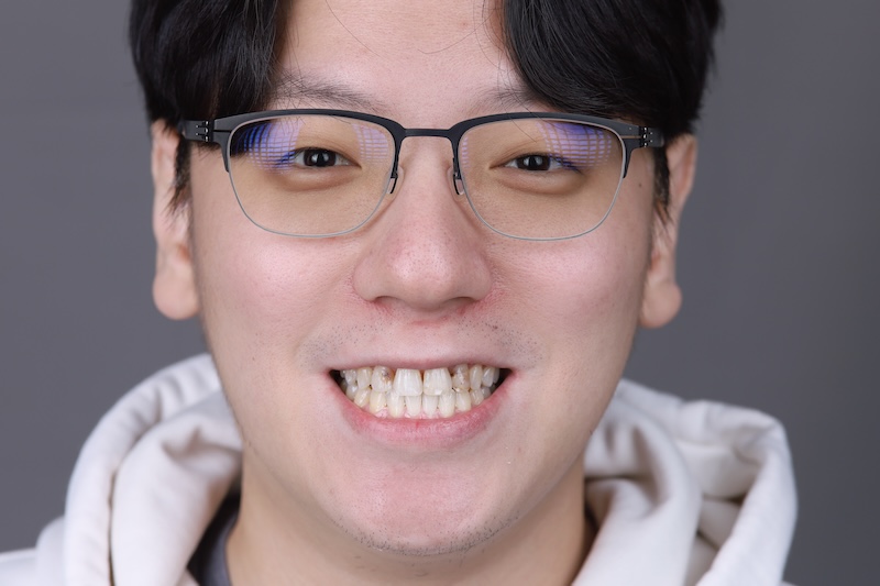 補牙變色造成色差，影響整體笑容外觀