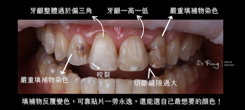 治療前牙齒近照，顯示樹脂補牙變色、染色與咬裂及色差等問題