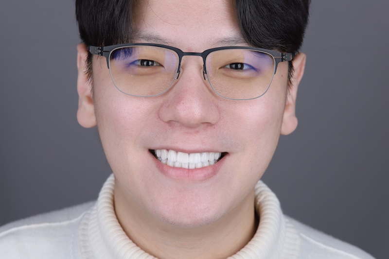 陶瓷貼片治療後患者笑容，自然亮白且與五官協調