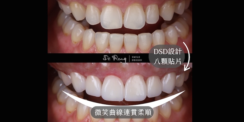 結合DSD數位微笑設計完成上排八顆陶瓷貼片，重建連貫柔順的牙齒比例與微笑曲線