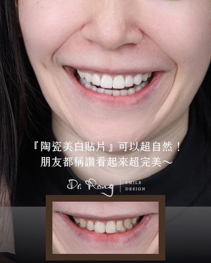 陶瓷貼片術後自然笑容效果，牙齒比例與微笑曲線更加協調