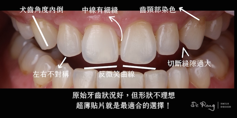 笑起來不好看療程前牙齒近照，包含牙齒小顆、中線細縫與切端縫隙過大等微笑曲線問題