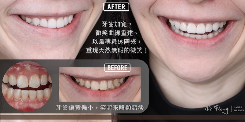 八顆陶瓷貼片前後對比，改善牙齒小顆並重建自然微笑曲線
