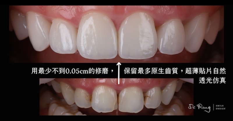 微創修磨後施作超薄陶瓷貼片，改善牙齒染色與排列不整前後對比