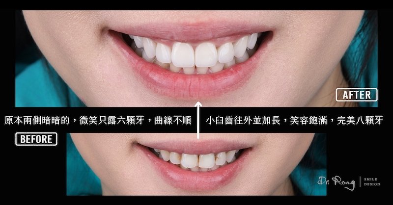 療程前笑起來只露六顆牙且曲線不順，陶瓷貼片改善後笑容呈現飽滿的八顆牙