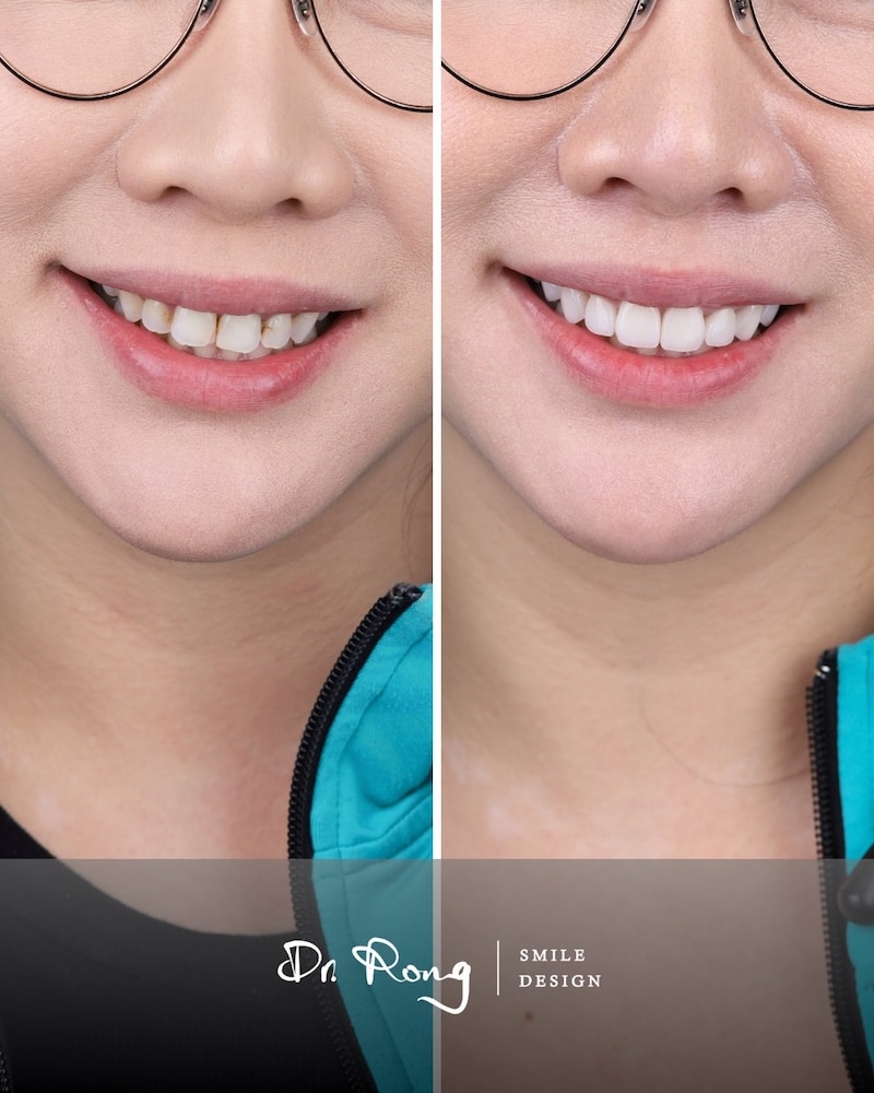 陶瓷貼片治療前後笑容對比，改善笑起來只露六顆牙讓笑容更飽滿
