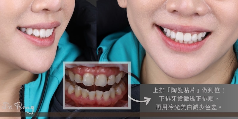 陶瓷貼片搭配微矯正與冷光美白，改善齒列與色差讓笑容更協調