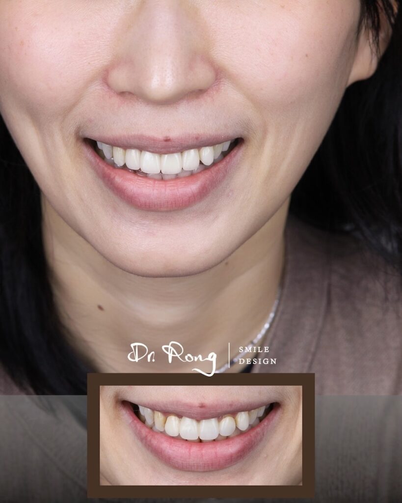 門牙假牙重做-假牙顏色不滿意-全瓷冠-推薦-許家榕醫師-台北