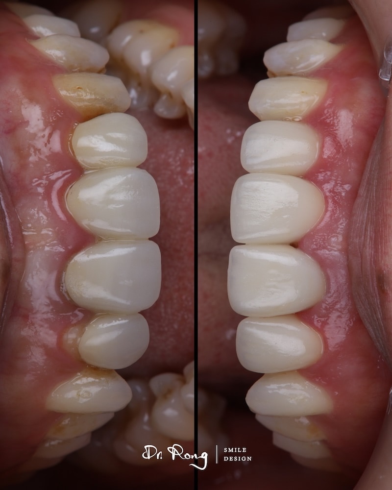 門牙假牙重做前後上排前牙對比,改善假牙不自然與不密合,重建自然色澤、和諧角度與牙齦健康