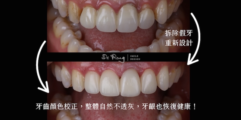 門牙假牙重做前後對比,四顆門牙全瓷冠重建自然色澤與弧度,牙齦恢復健康