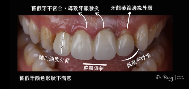 門牙假牙不自然與假牙不密合的治療前特寫,伴隨牙齦發炎、邊緣發黑及外傾問題