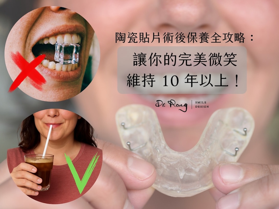 陶瓷貼片術後保養-台北-推薦-許家榕醫師