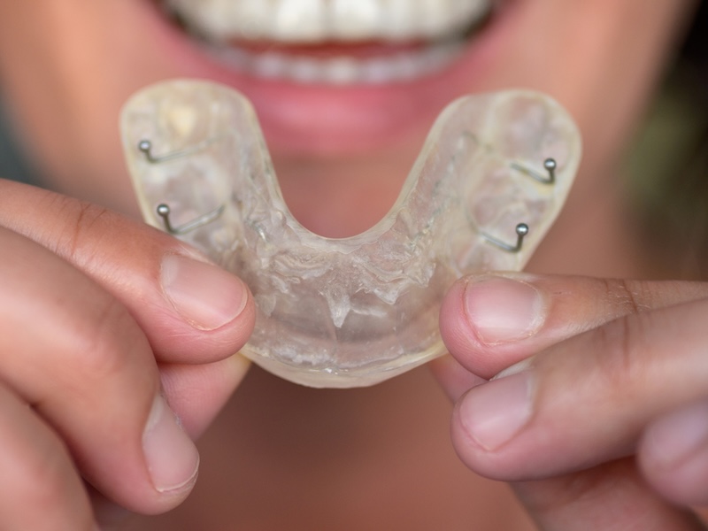 客製化夜間咬合板，用於保護陶瓷貼片避免磨牙損傷