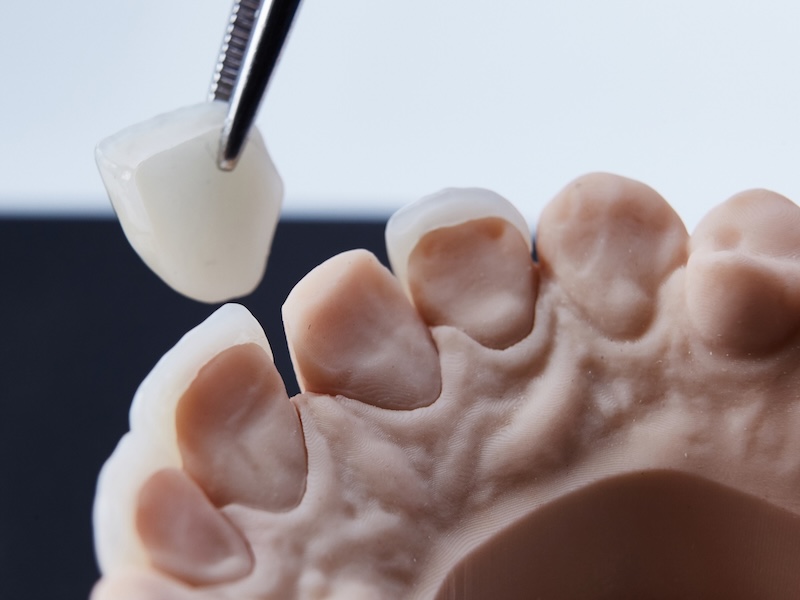 陶瓷貼片底下的原生牙齒結構示意圖