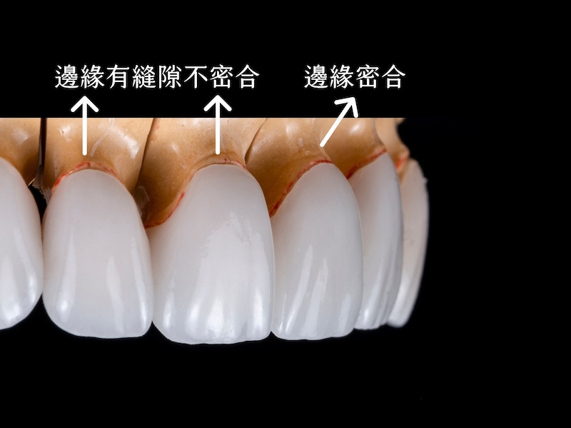 陶瓷貼片邊緣不密合造成滲透的示意圖
