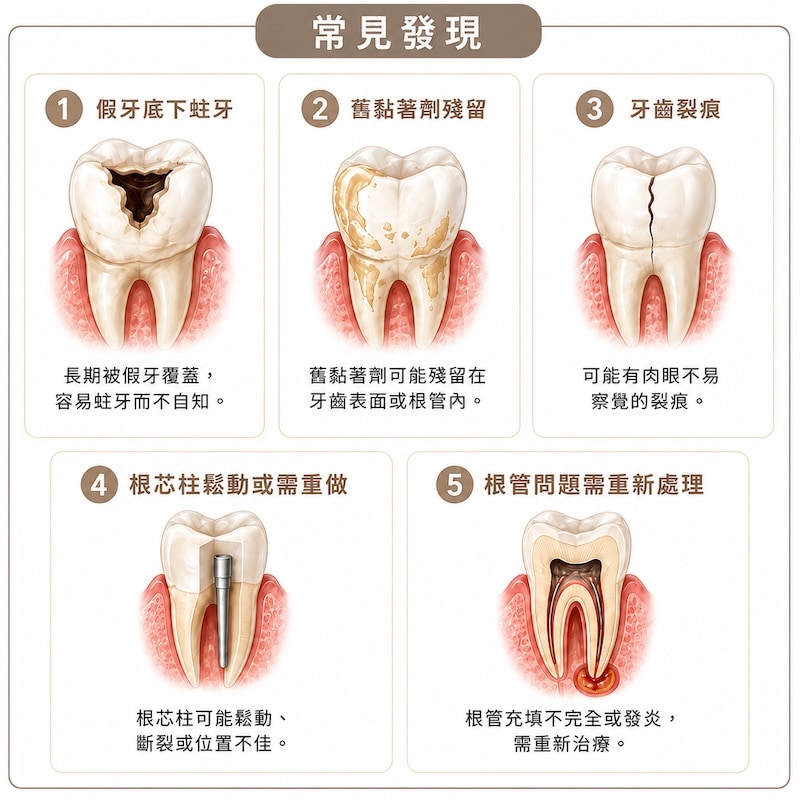 假牙拆除後常見問題示意圖，包括蛀牙、牙齒裂痕與根管問題等