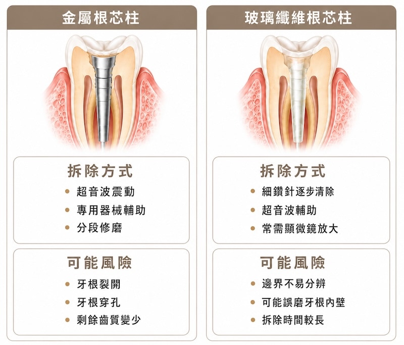 金屬牙釘與玻璃纖維牙釘拆除方式與風險比較示意圖